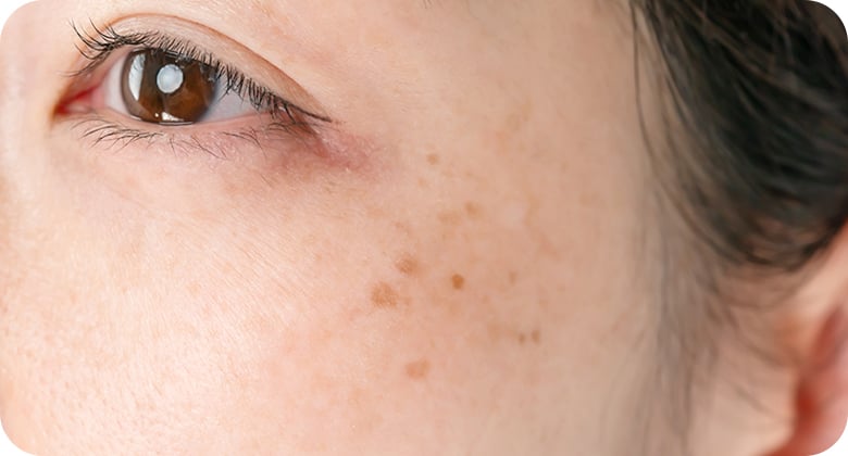 ADM（後天性真皮メラノサイトーシス）