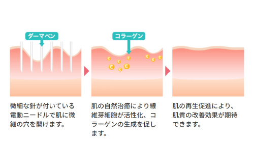 ダーマペンに期待できる効果