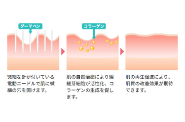 ダーマペンの効果のメカニズムとは？