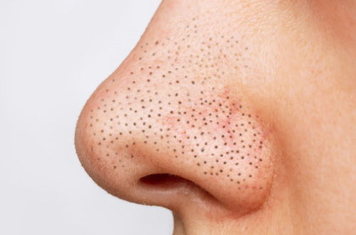 いちご鼻ができる原因