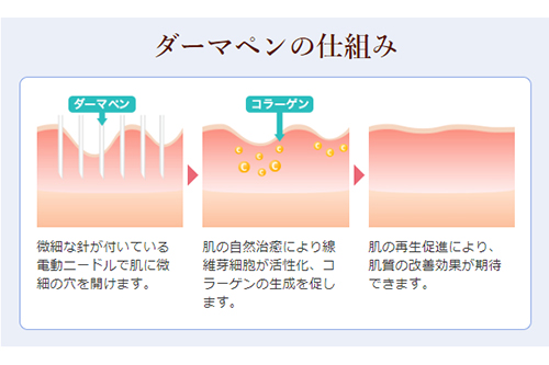 ダーマペンの仕組み