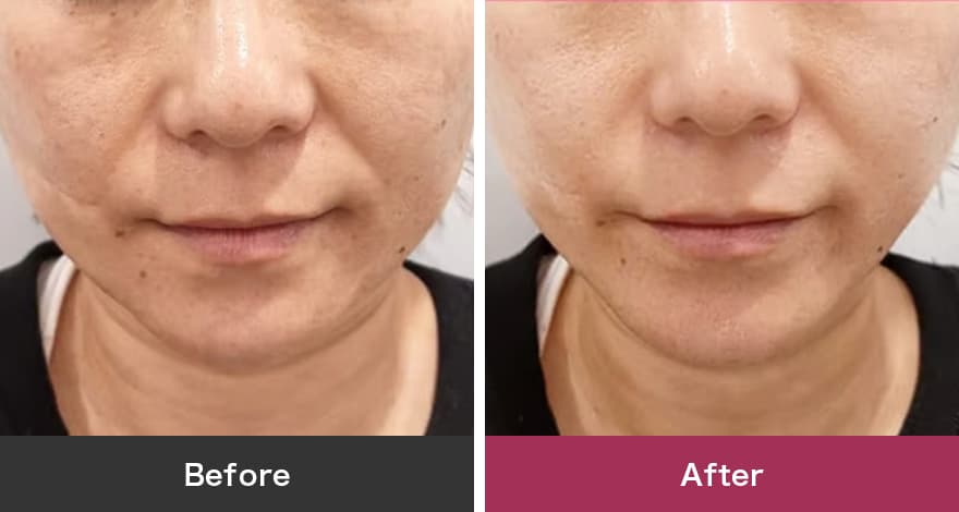 水玉スキン 症例写真