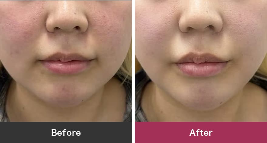 水玉スキン 症例写真