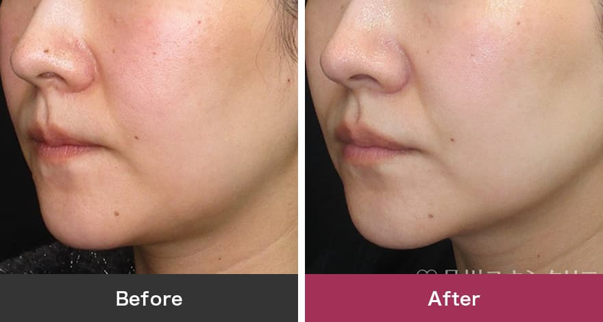 レーザートーニング 症例写真