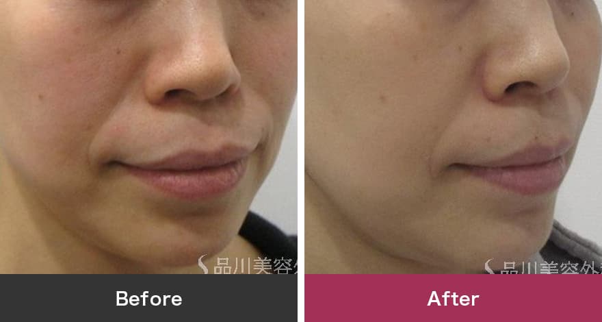 フォトシルクプラス 症例写真