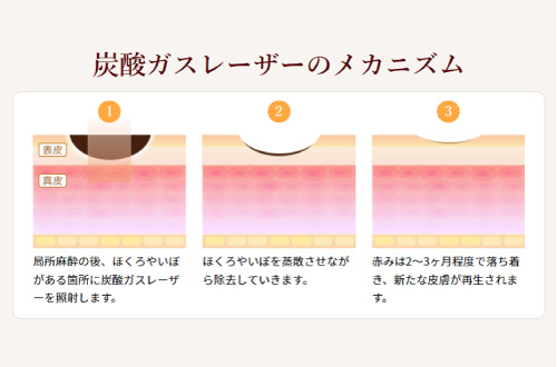 炭酸ガスレーザーの場合
