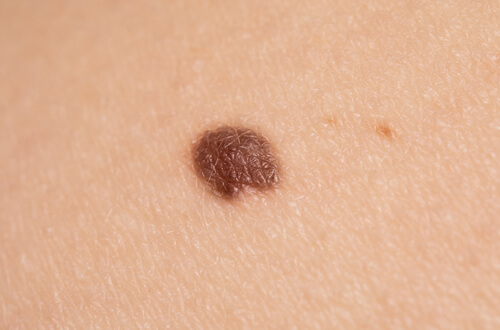 「ほくろ」とはどんなもの？