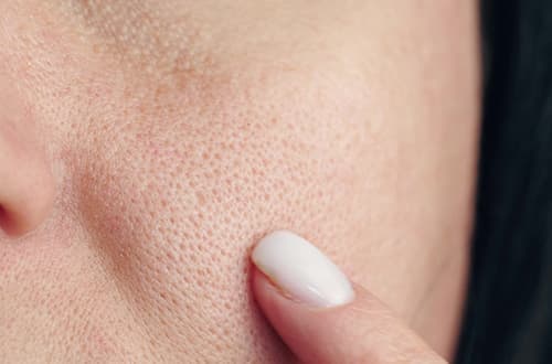 毛穴の開きとはどのような状態を指す？