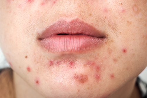 ニキビについての基本知識