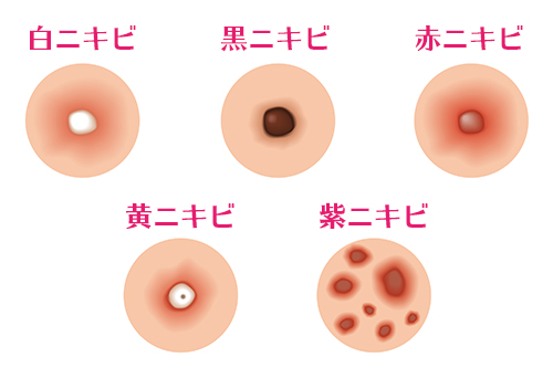 いろいろなニキビの種類