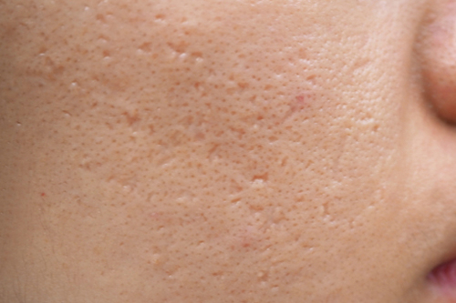 ニキビ跡ができる原因