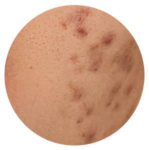 色素沈着を起こすタイプ