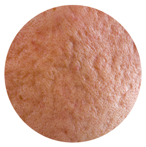 皮膚が凸凹してしまうクレータータイプ