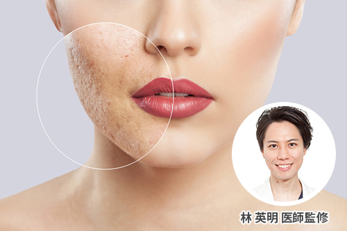 ニキビ跡って治せるの！？ニキビ跡のタイプと治療法を解説【医師監修】