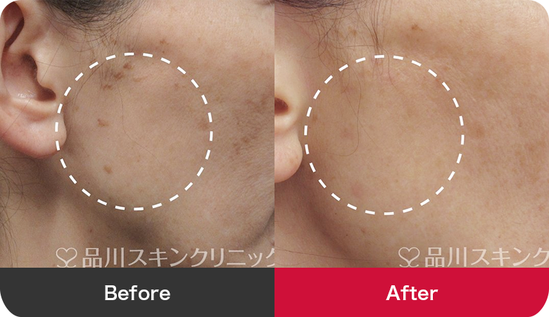 シミ取り治療の症例写真【画像】