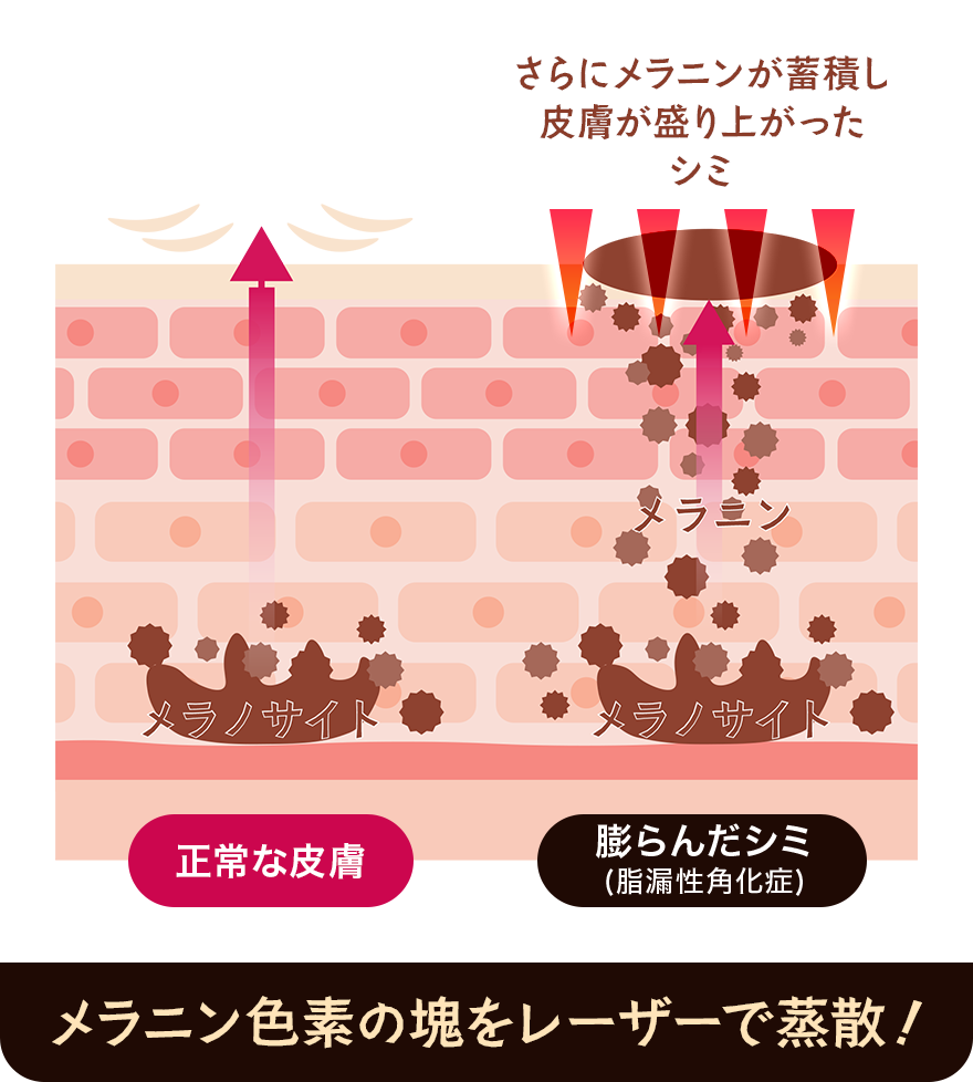 レーザーでメラニン色素を破壊！