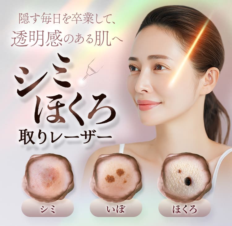 隠す毎日を卒業して、透明感のある肌へ/シミ・ほくろ取りレーザー/シミ/いぼ/ほくろ