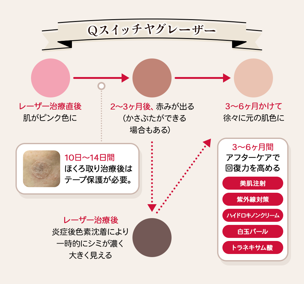 Qスイッチヤグレーザー