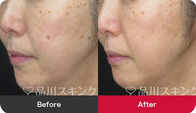 シミ取り治療の症例写真【画像】