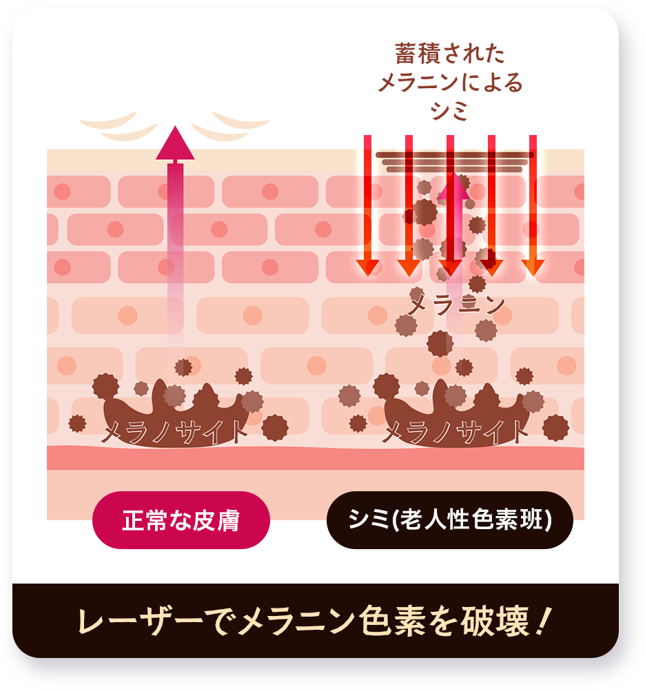 レーザーでメラニン色素を破壊！