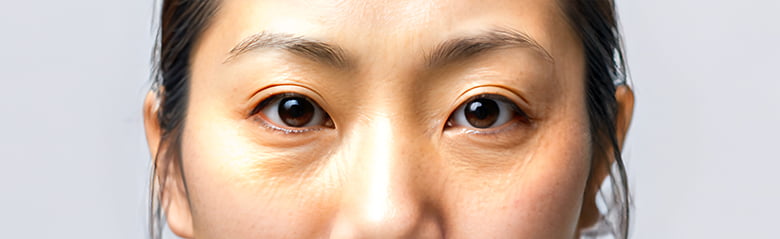 ちりめんじわの原因と改善方法｜目の下・目元の小ジワの治し方を医師が解説