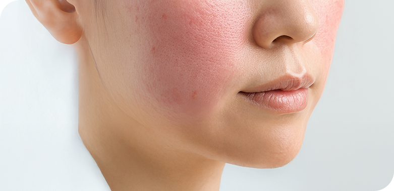 赤いニキビ跡や赤ら顔も改善