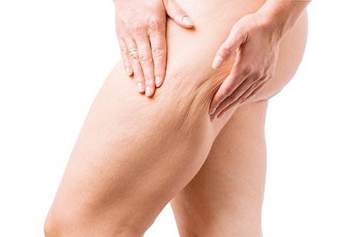 太もも・お尻・二の腕…セルライトの予防＆改善ポイントとは？