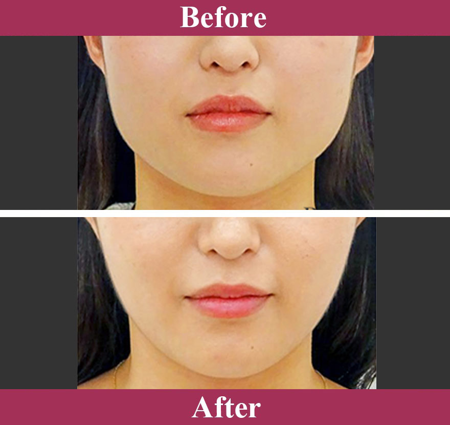 ボトックス注射（アラガン社製）症例写真【画像】