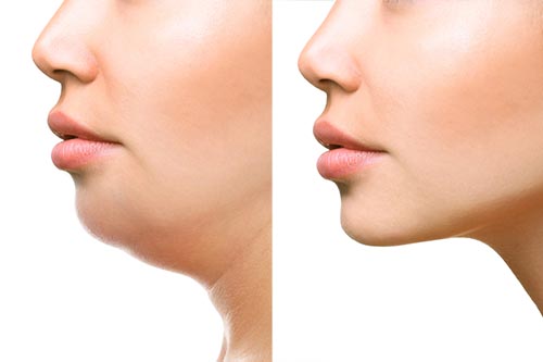 顔太りはキレイの大敵