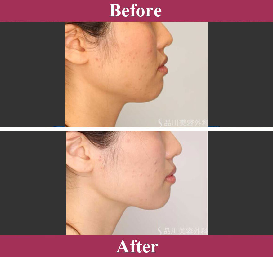 1日脂肪取り&reg;顔やせ（脂肪溶解注射）症例写真【画像】