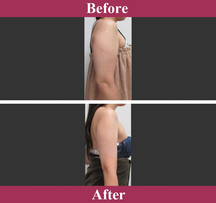 エバー・スリム&reg; 最新1日脂肪取り スリム・プログラム&reg;症例写真【画像】