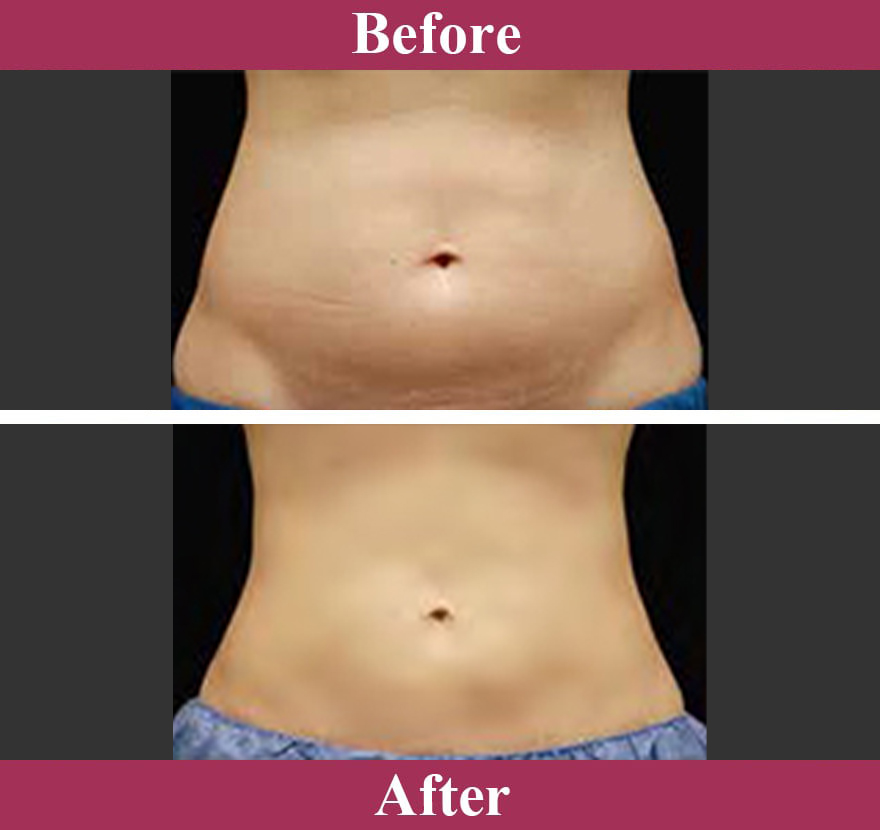 クールスカルプティング&reg;症例写真【画像】