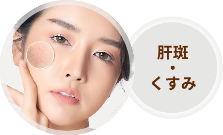 肝斑・くすみ：全顔（1回）【画像】